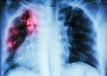 Atenção: Vulnerabilidade social desafia o combate à tuberculose, afirma especialista